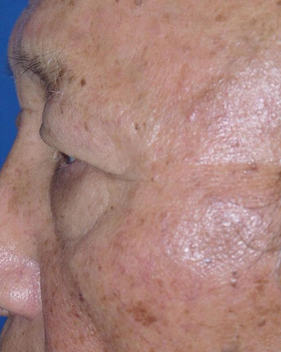 Eyelid Surgery, Left Profile view, before