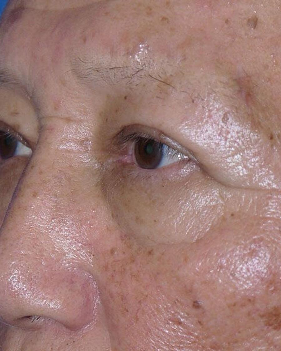 Eyelid Surgery after