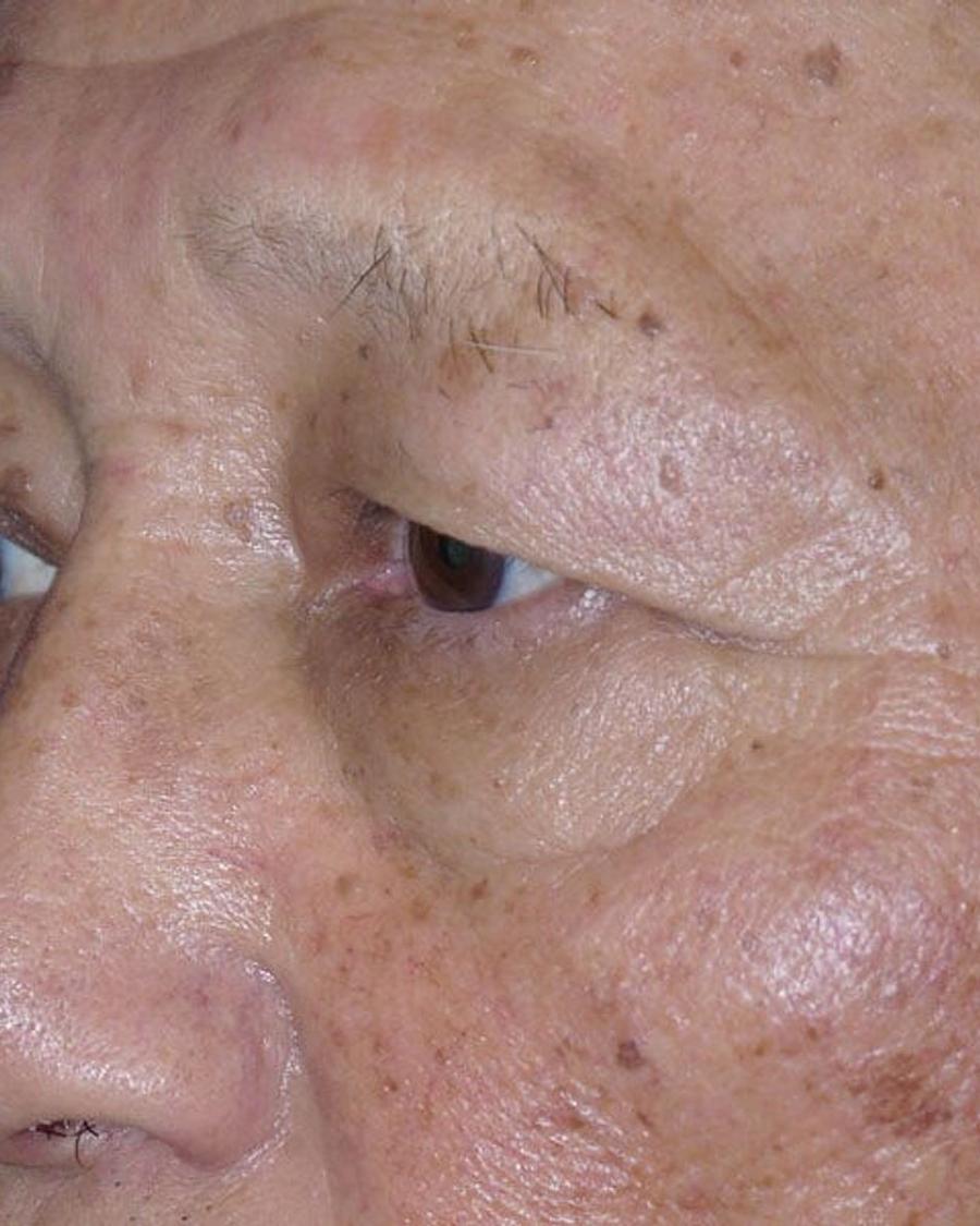 Eyelid Surgery before