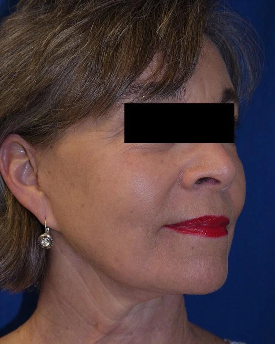 Facelift (neck lift included) after