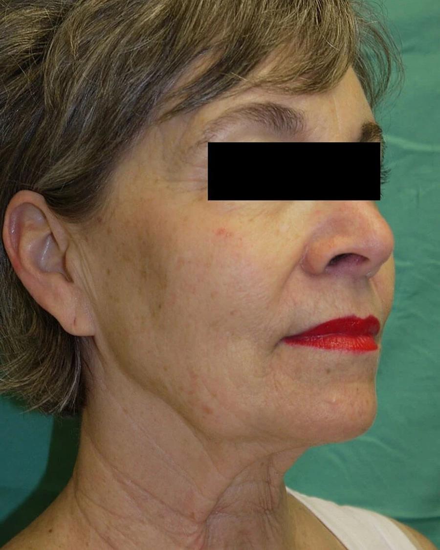 Facelift (neck lift included) before