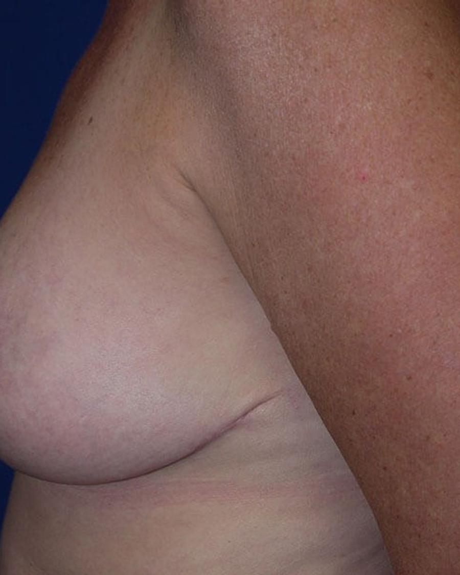 Breast Reduction, Left Profile view, after