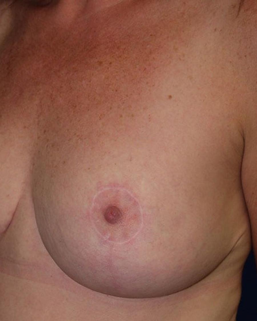 Breast Reduction, Oblique Right view, after
