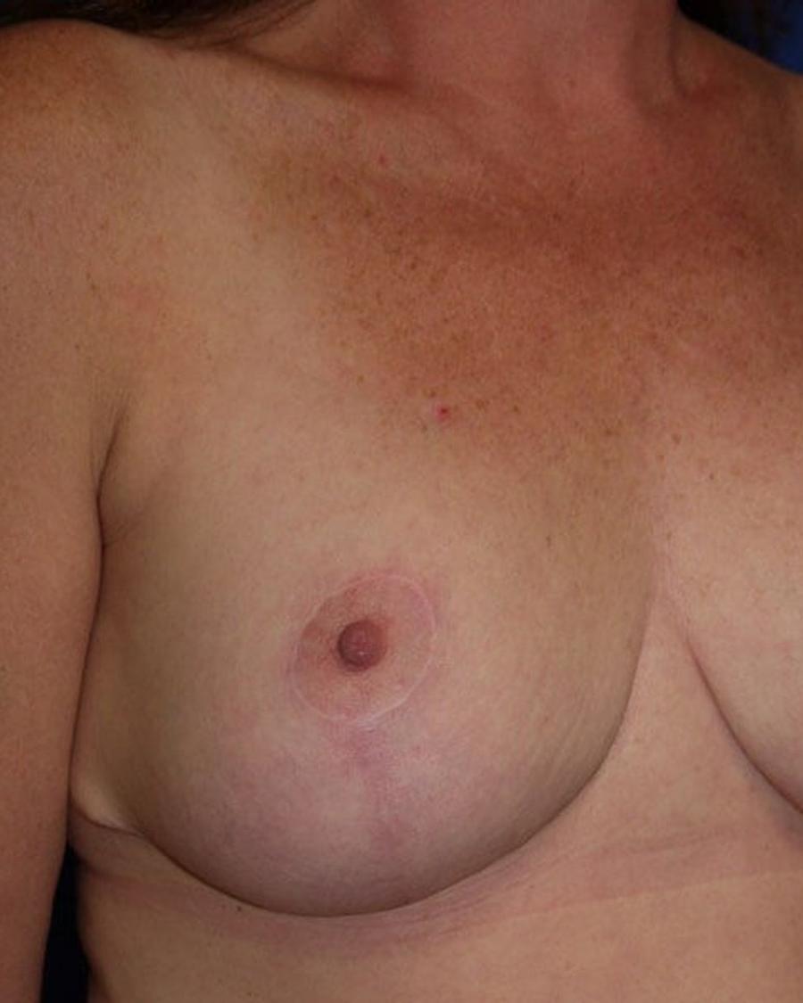 Breast Reduction after