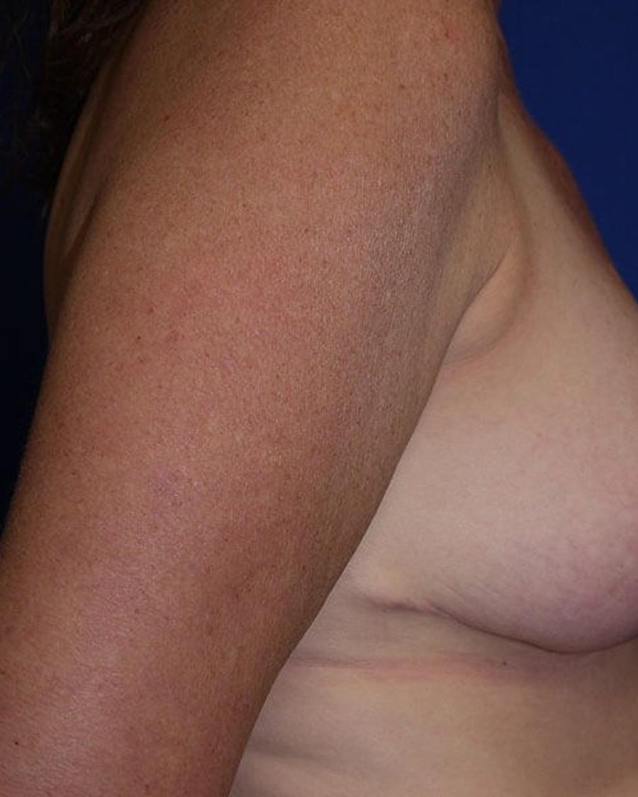 Breast Reduction, Right Profile view, after