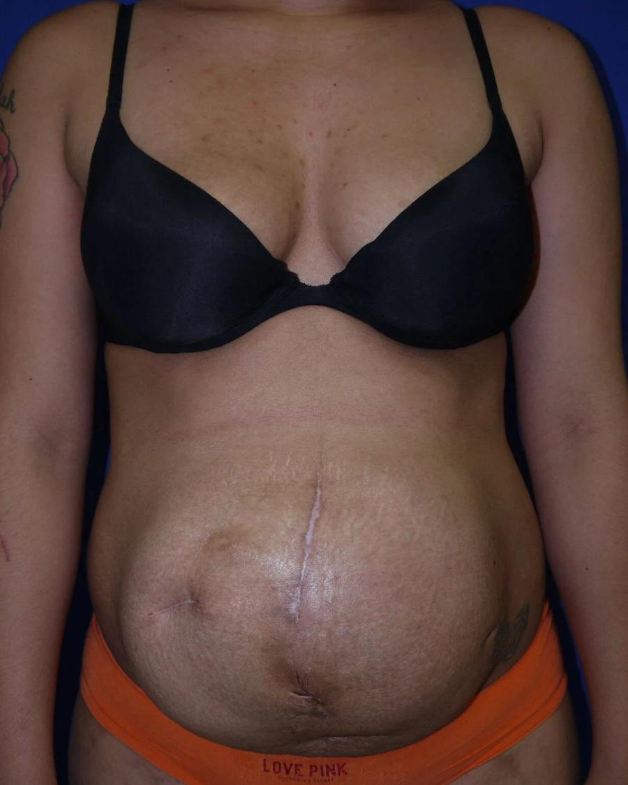 Tummy Tuck before