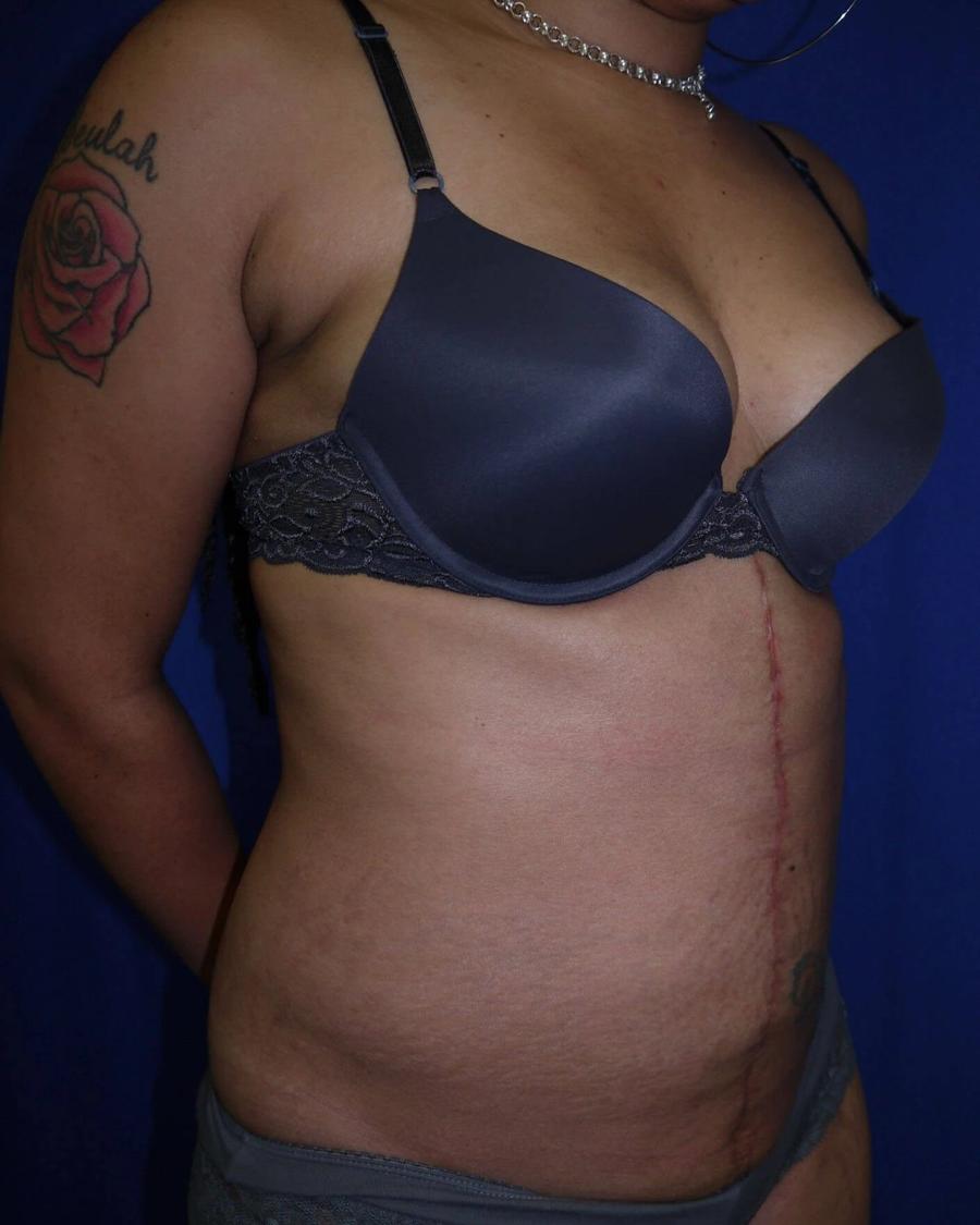 Tummy Tuck after