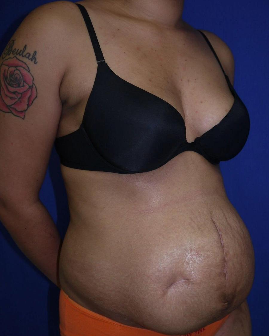Tummy Tuck before