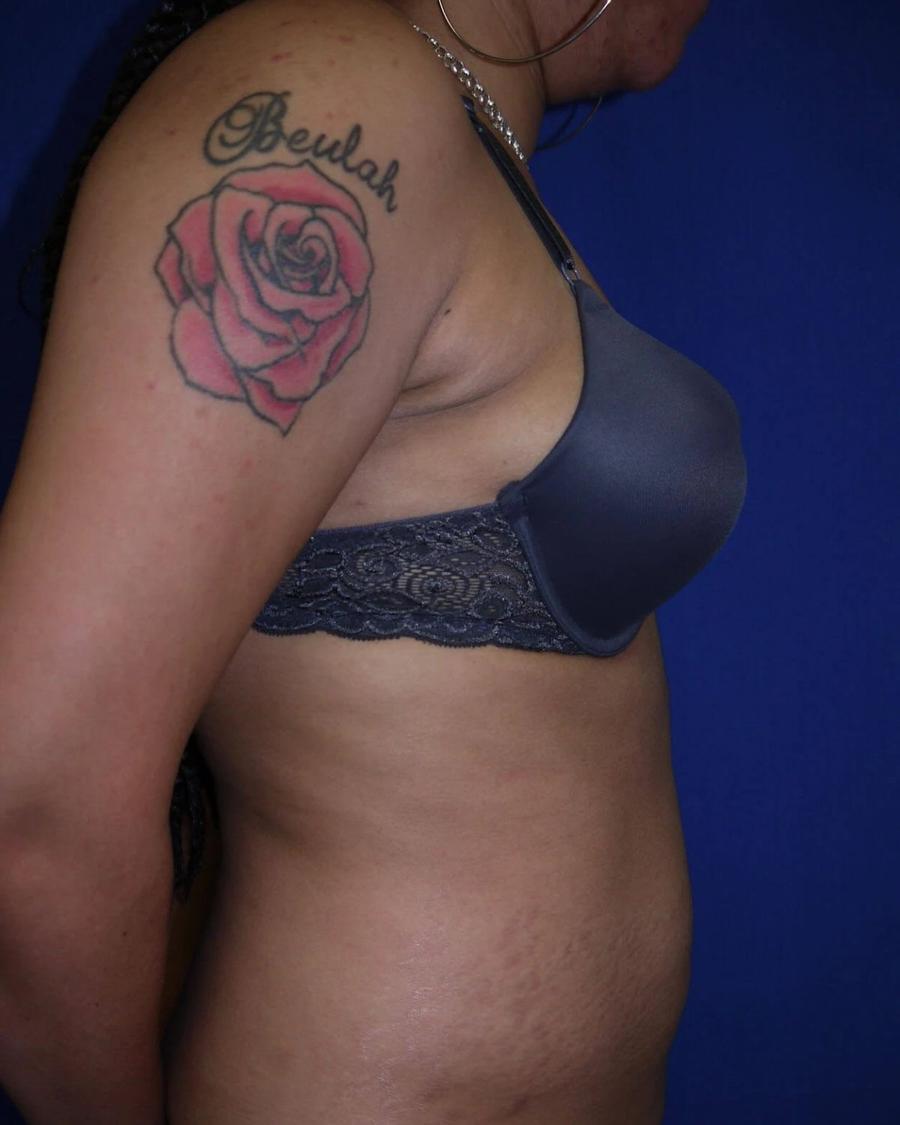 Tummy Tuck, Right Profile view, after