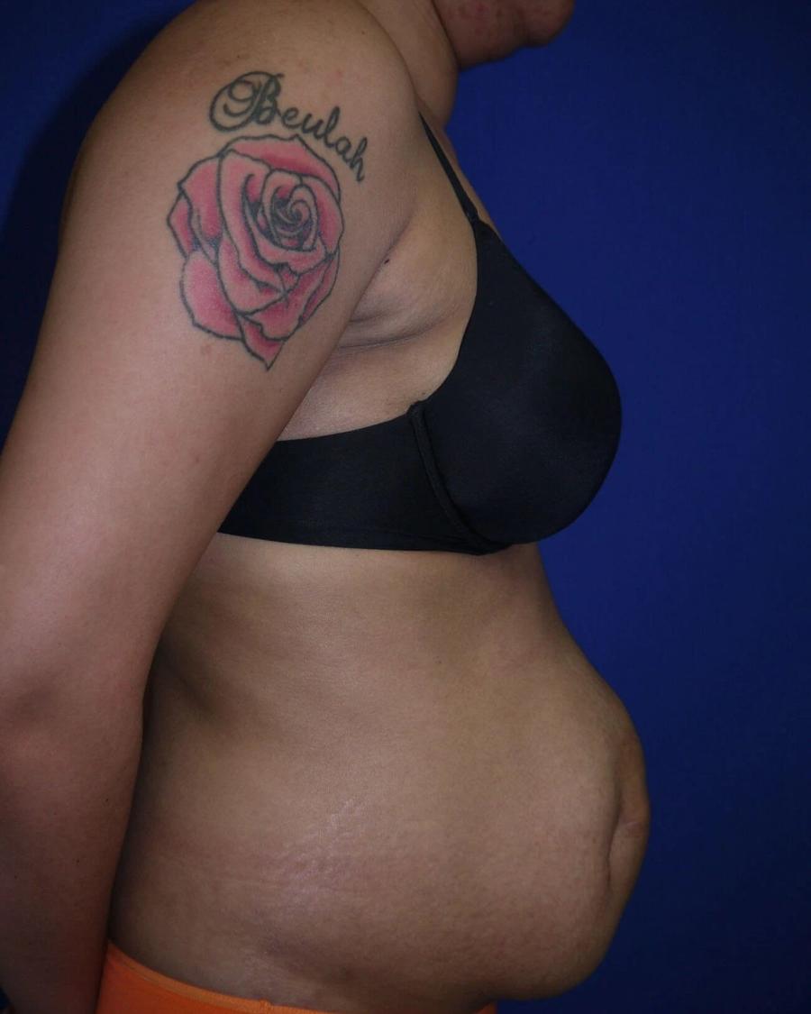Tummy Tuck, Right Profile view, before