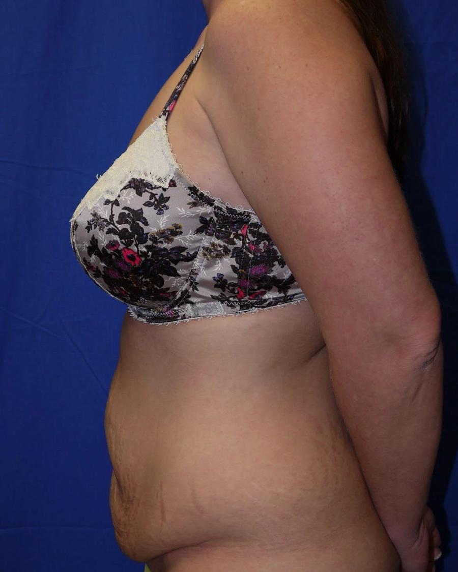 Tummy Tuck, Left Profile view, before