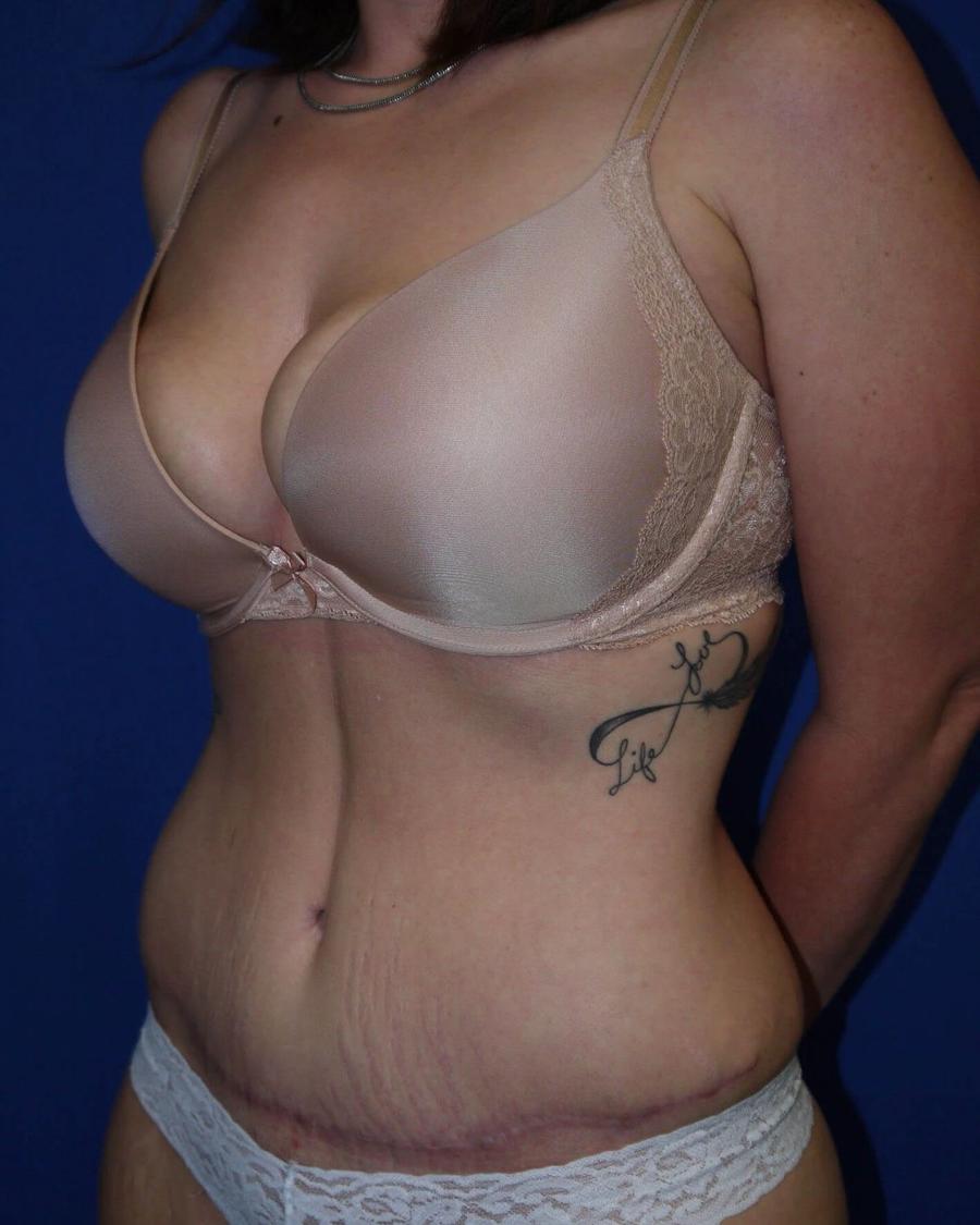 Tummy Tuck, Oblique Right view, after