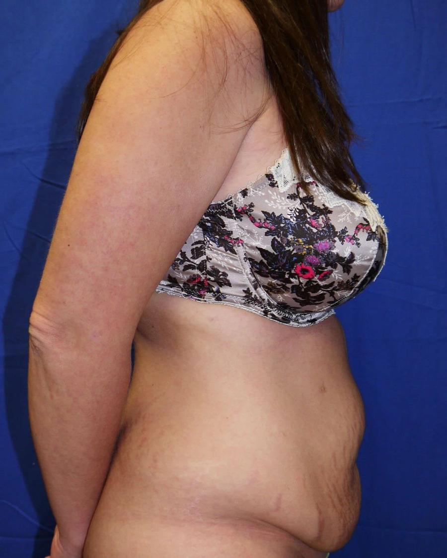 Tummy Tuck, Right Profile view, before
