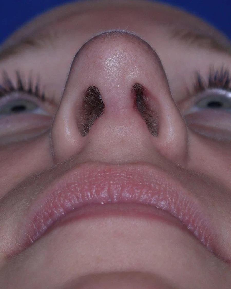 Rhinoplasty after