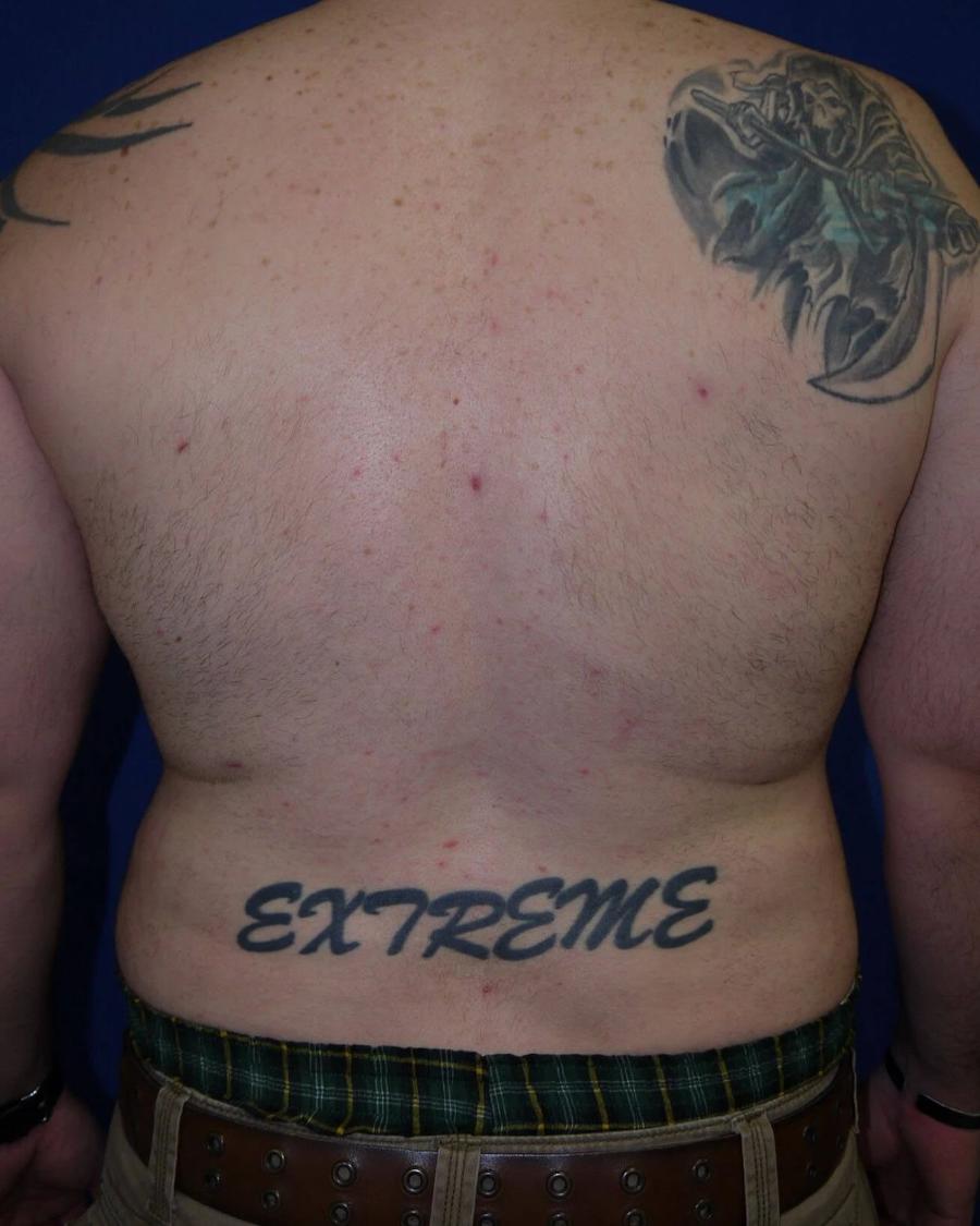 Tummy Tuck, Back view, after