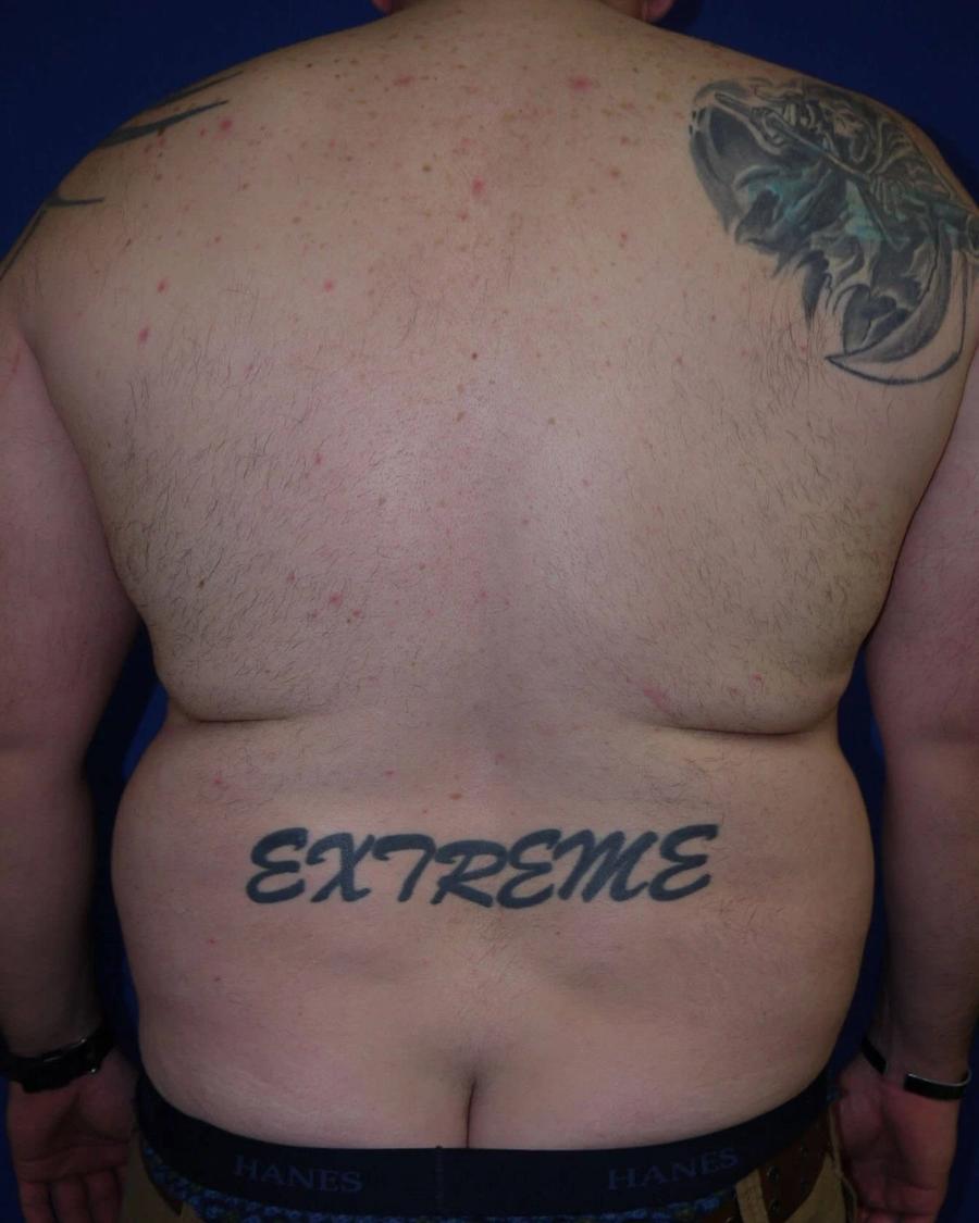 Tummy Tuck, Back view, before