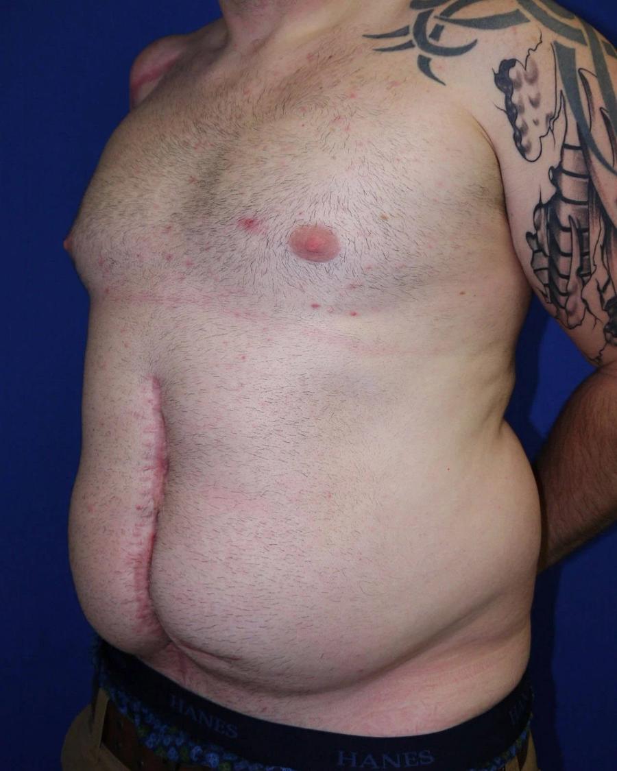 Tummy Tuck before