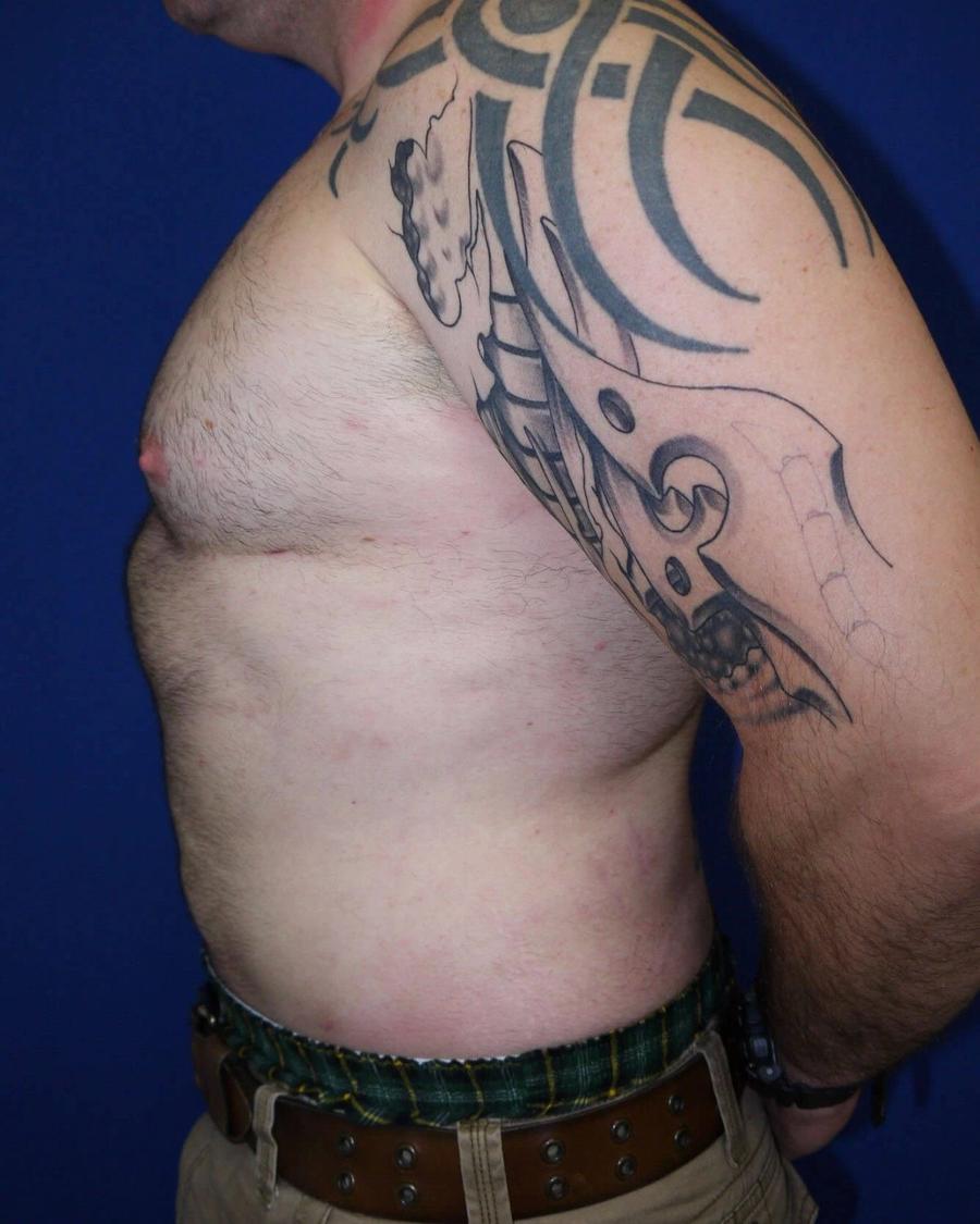 Tummy Tuck, Left Profile view, after
