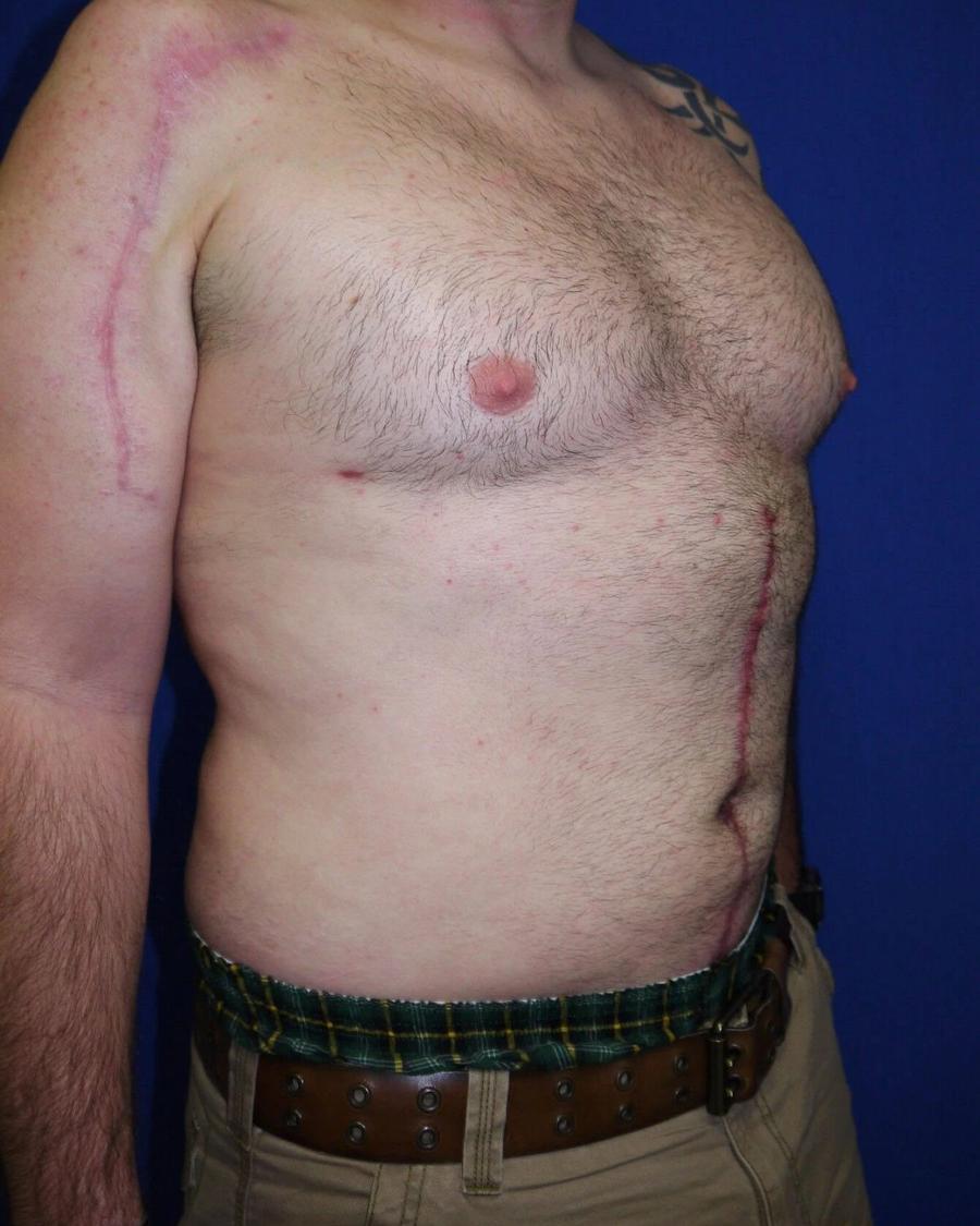 Tummy Tuck, Oblique Right view, after