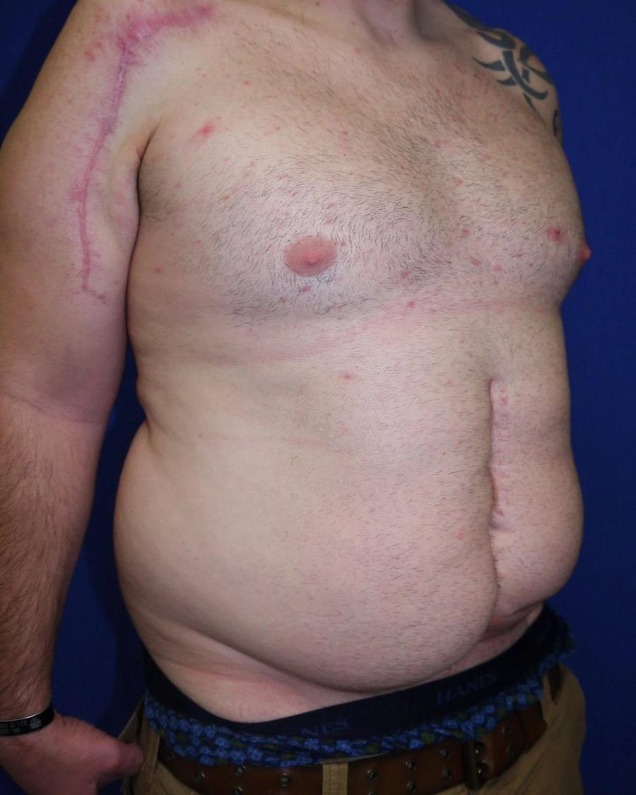 Tummy Tuck, Oblique Right view, before