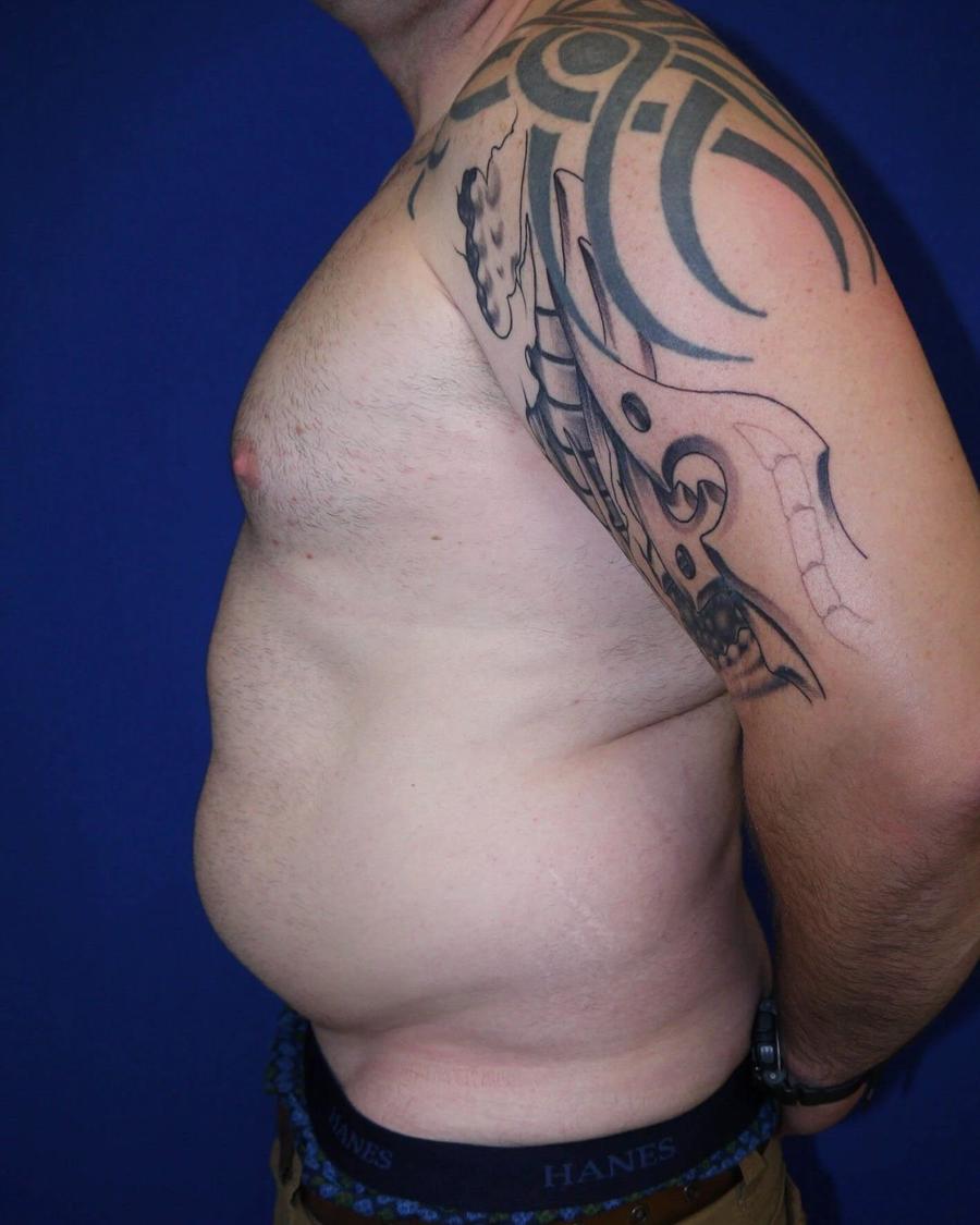Tummy Tuck, Right Profile view, before