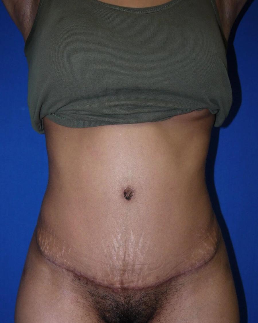 Tummy Tuck after