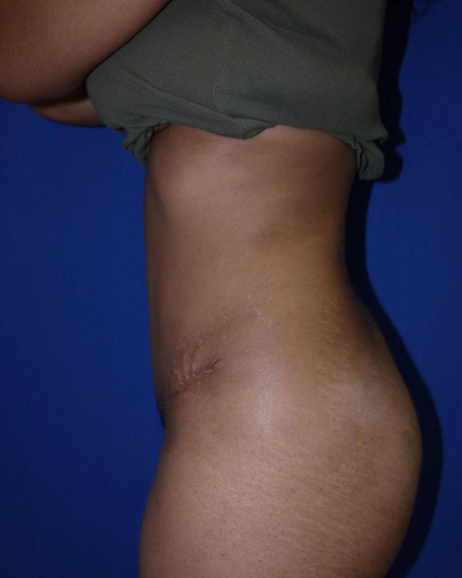 Tummy Tuck, Left Profile view, after