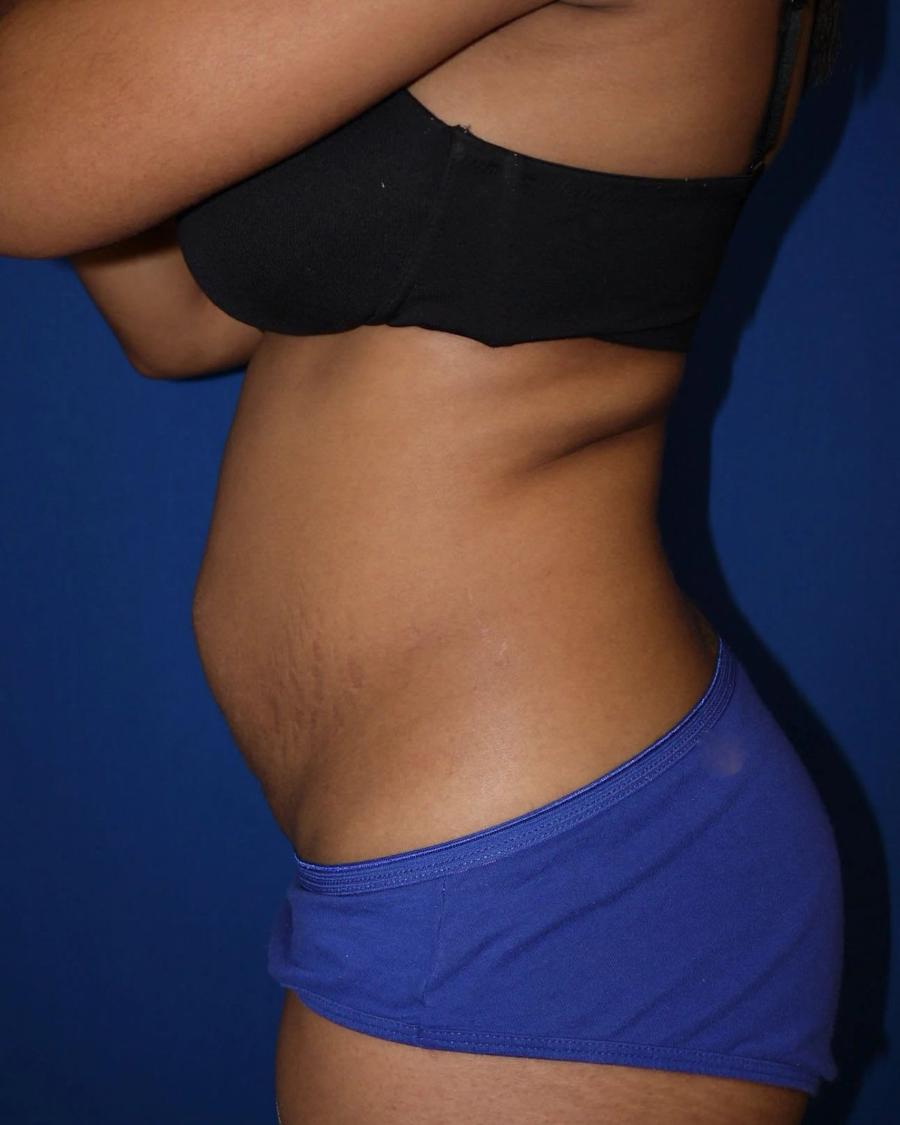 Tummy Tuck, Left Profile view, before