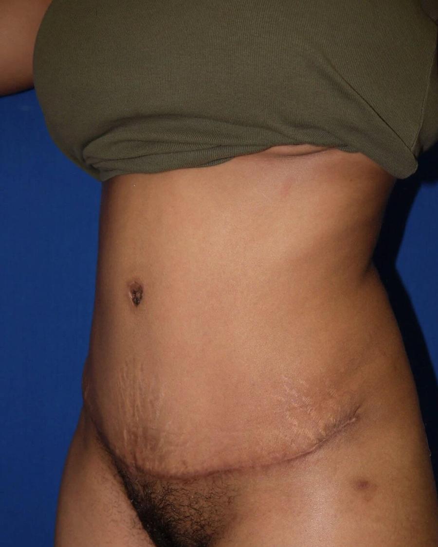 Tummy Tuck, Oblique Right view, after