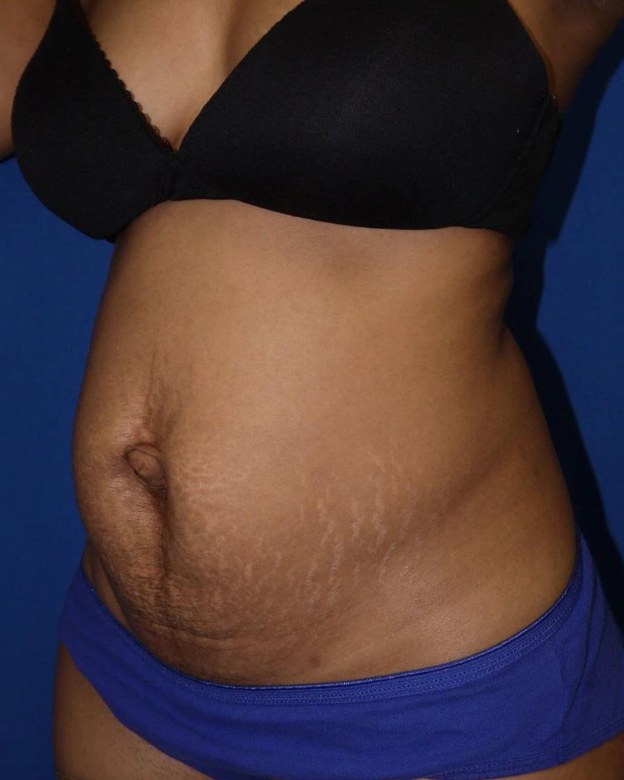 Tummy Tuck, Oblique Right view, before