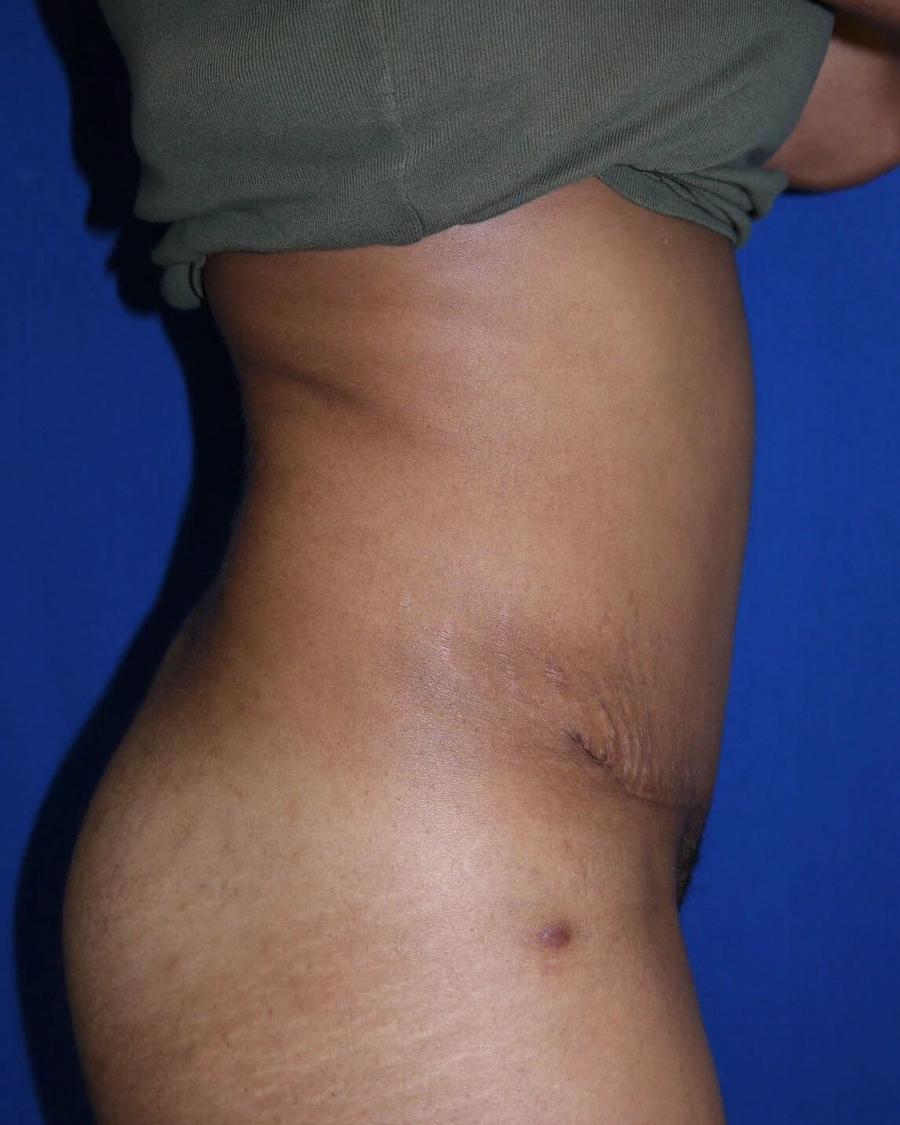 Tummy Tuck, Right Profile view, after
