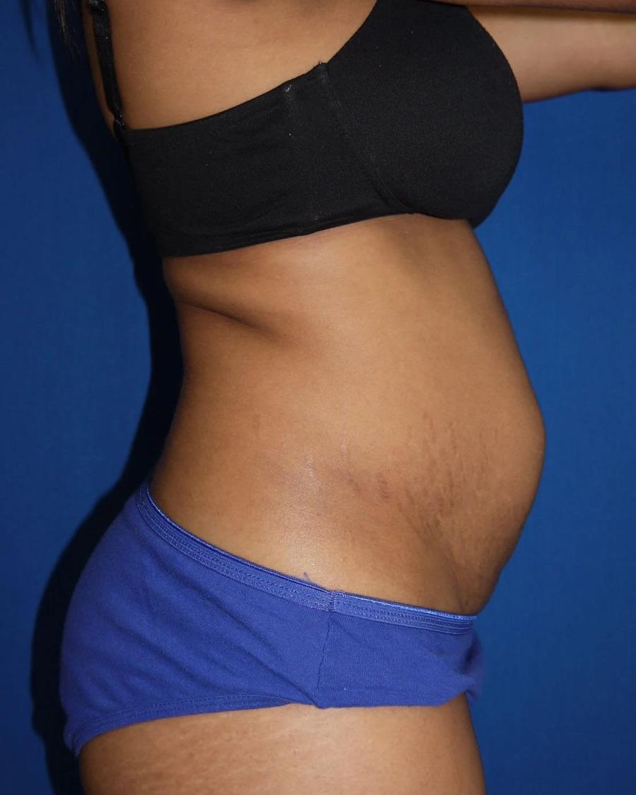 Tummy Tuck, Right Profile view, before