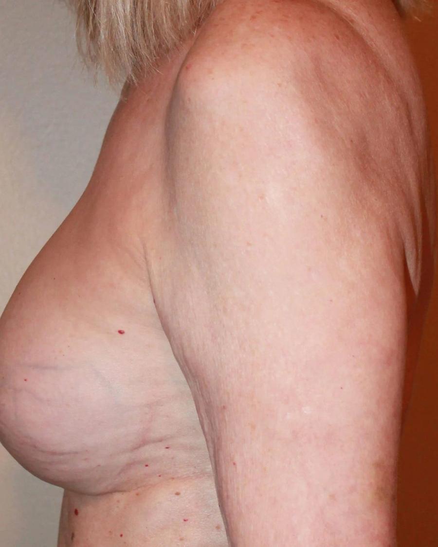 Breast Augmentation with Implants after