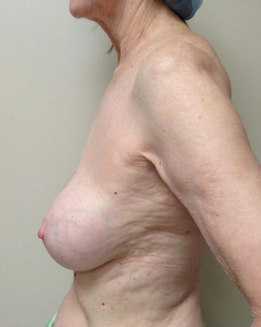 Breast Augmentation with Implants before