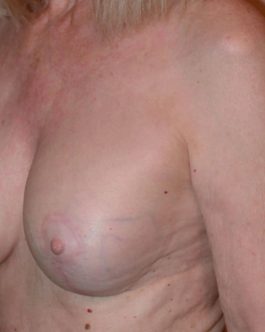 Breast Augmentation with Implants, Oblique Right view, after