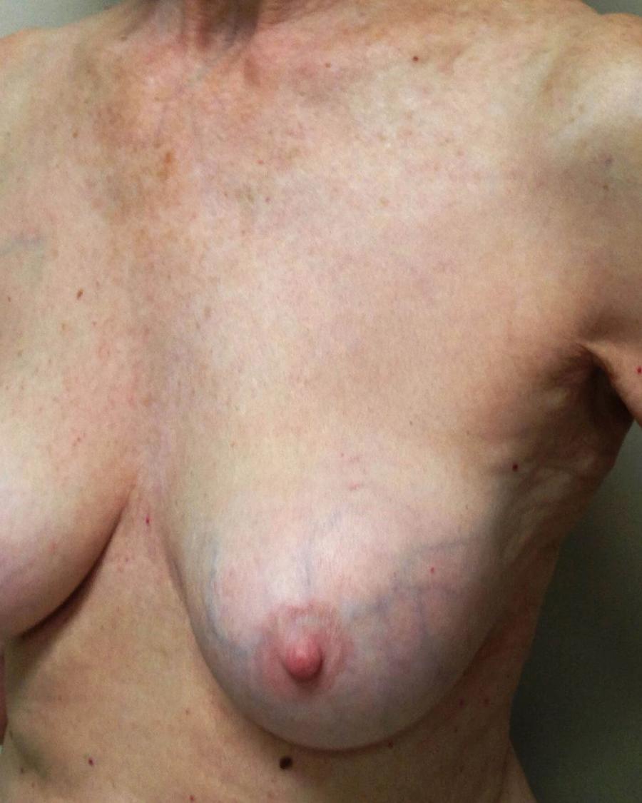 Breast Augmentation with Implants, Oblique Right view, before