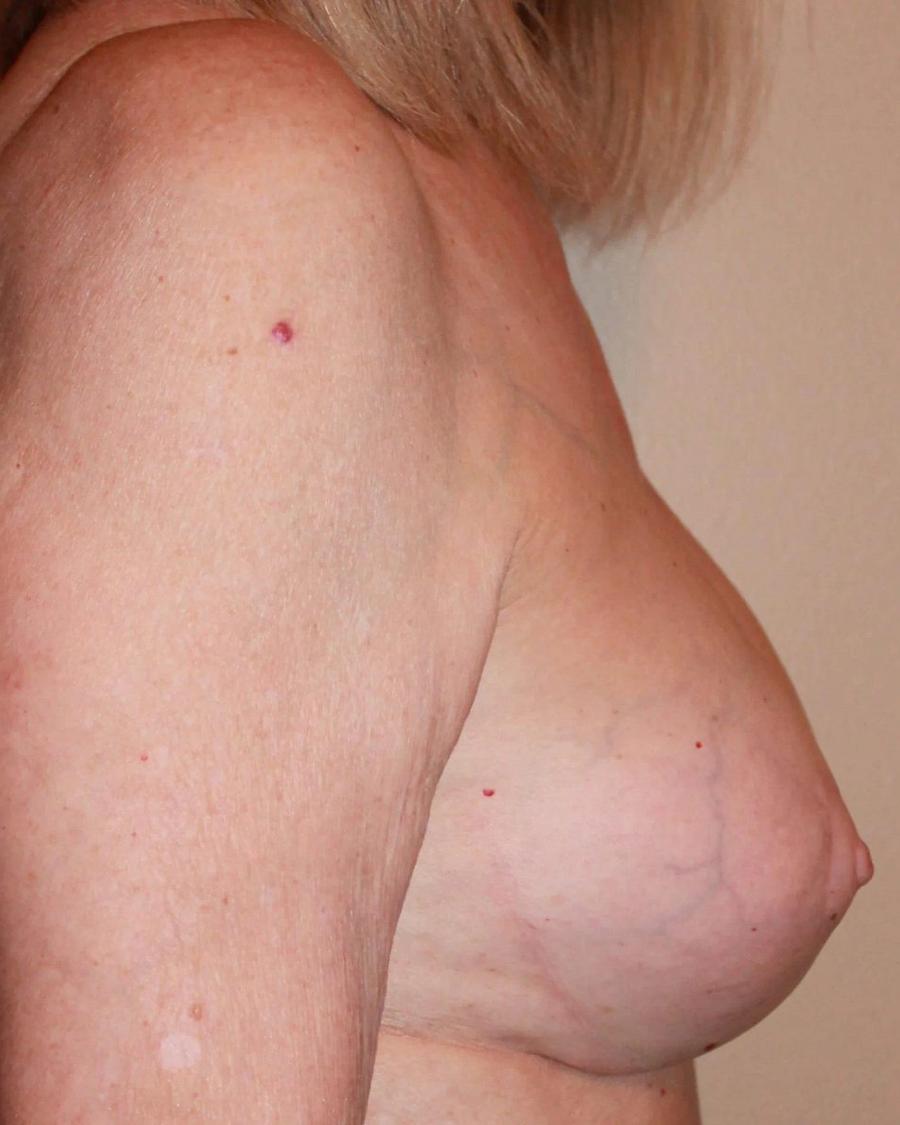 Breast Augmentation with Implants, Right Profile view, after