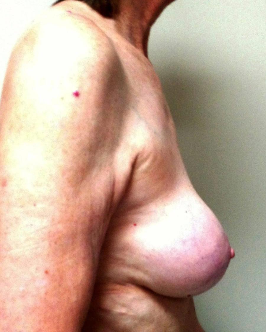 Breast Augmentation with Implants, Right Profile view, before