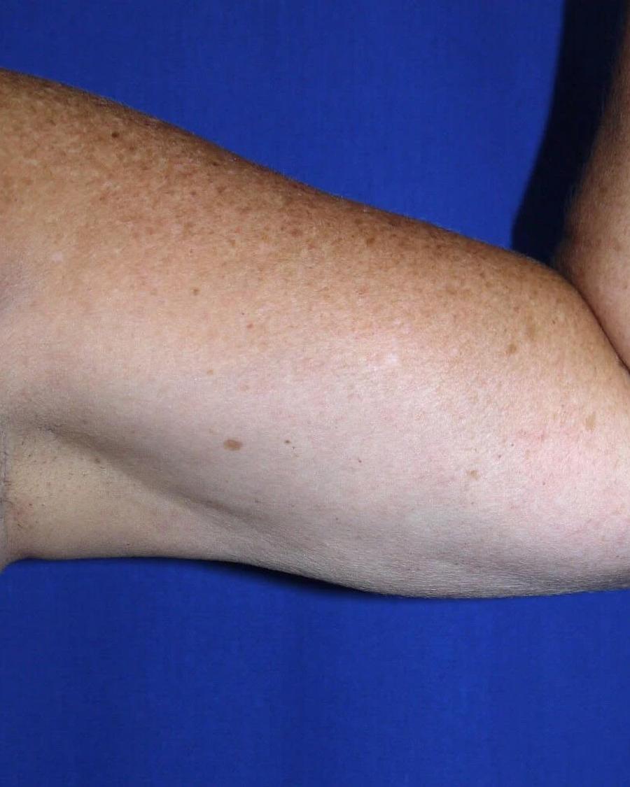 Arm Lift, Oblique Left view, after