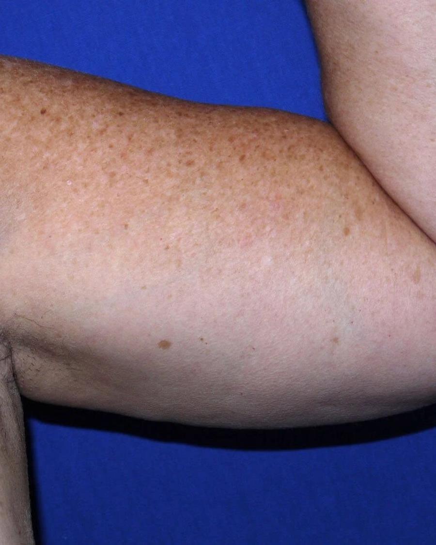 Arm Lift, Oblique Left view, before