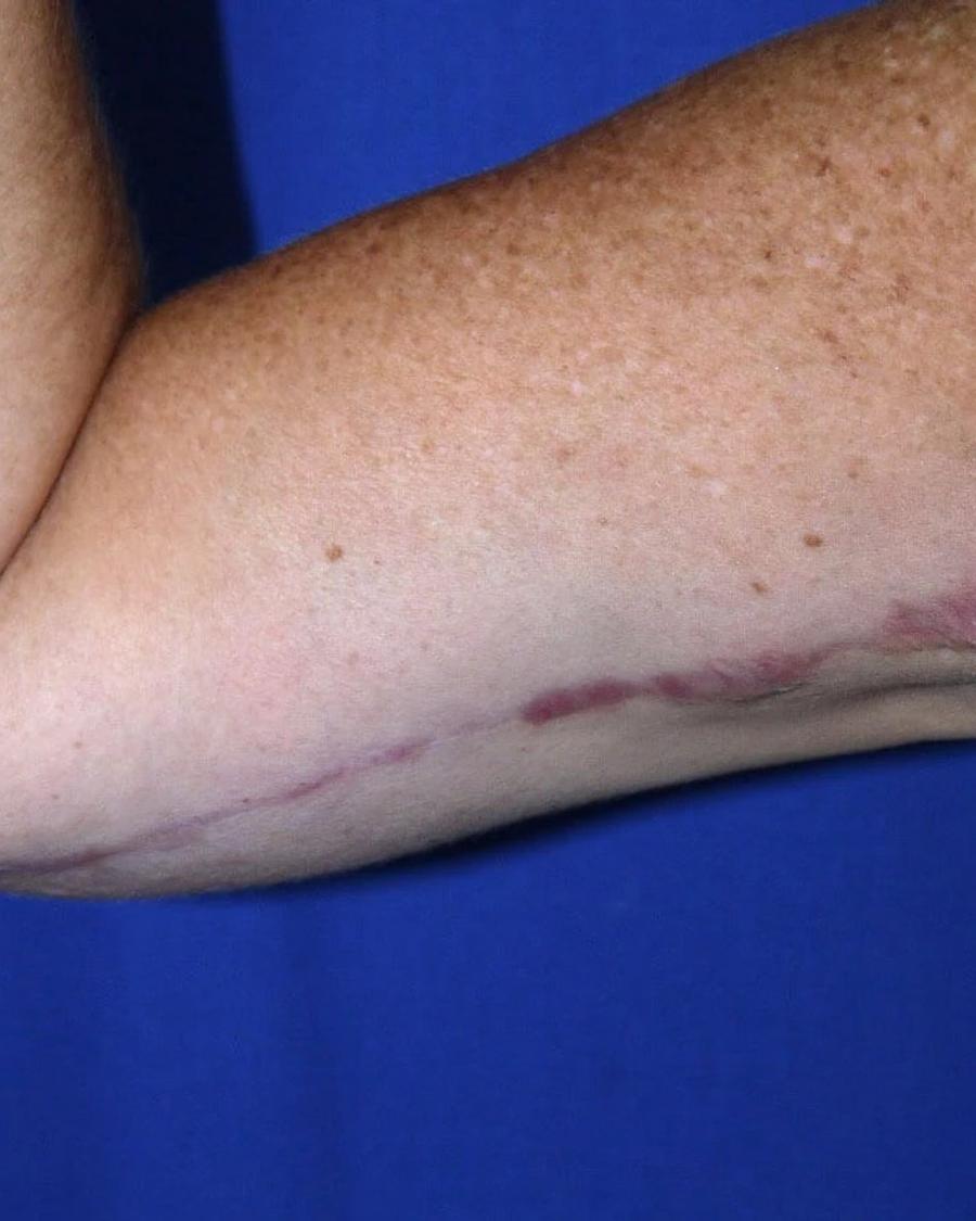Arm Lift after