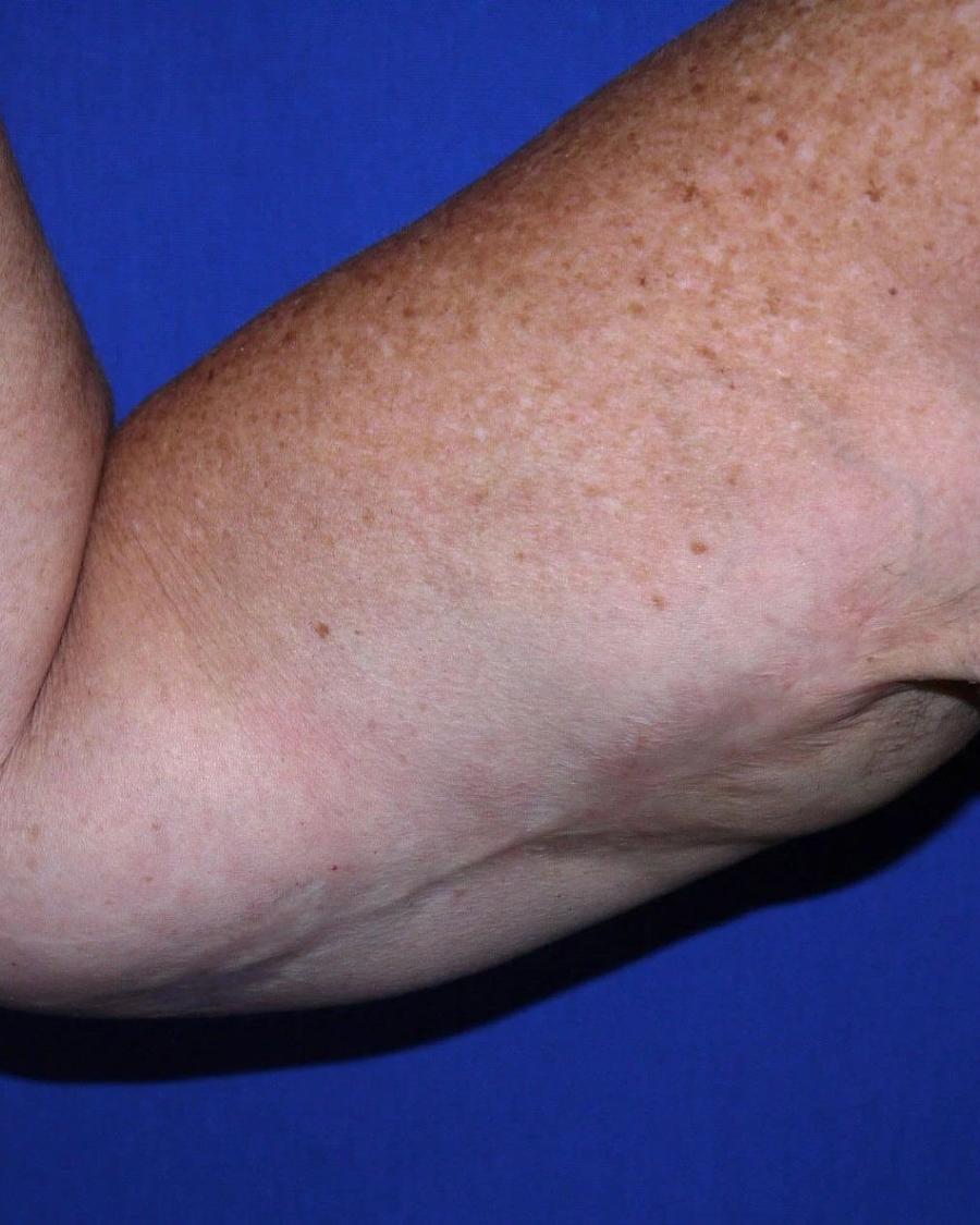 Arm Lift before