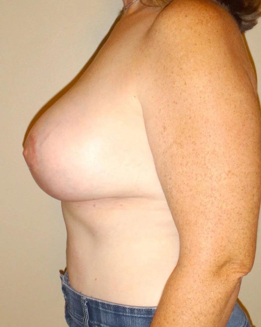 Breast Augmentation with Implants, Left Profile view, after