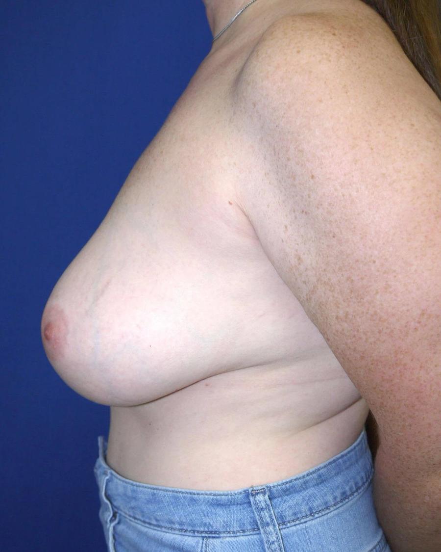 Breast Augmentation with Implants, Left Profile view, before