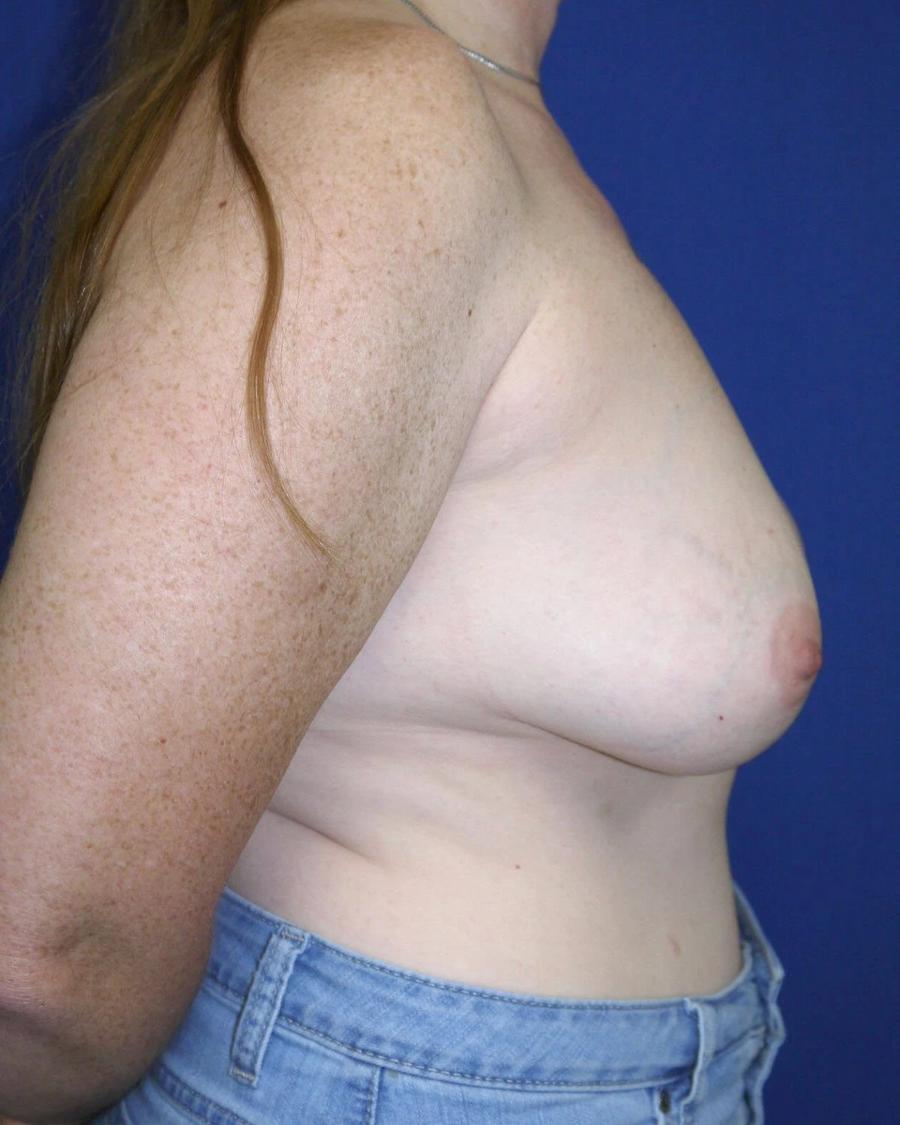 Breast Augmentation with Implants, Right Profile view, before