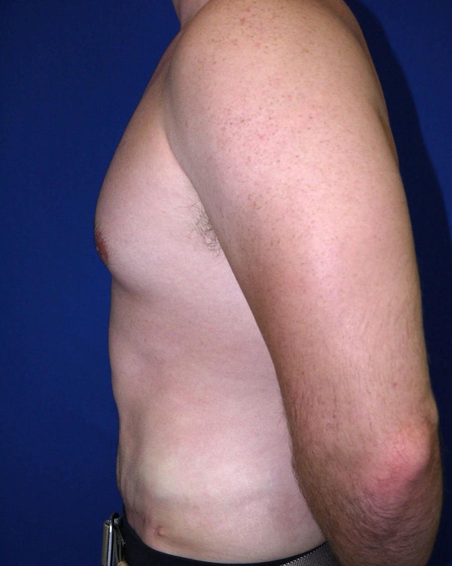 Tummy Tuck, Left Profile view, after