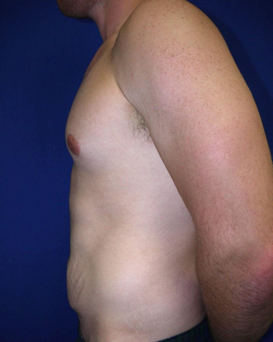 Tummy Tuck, Left Profile view, before