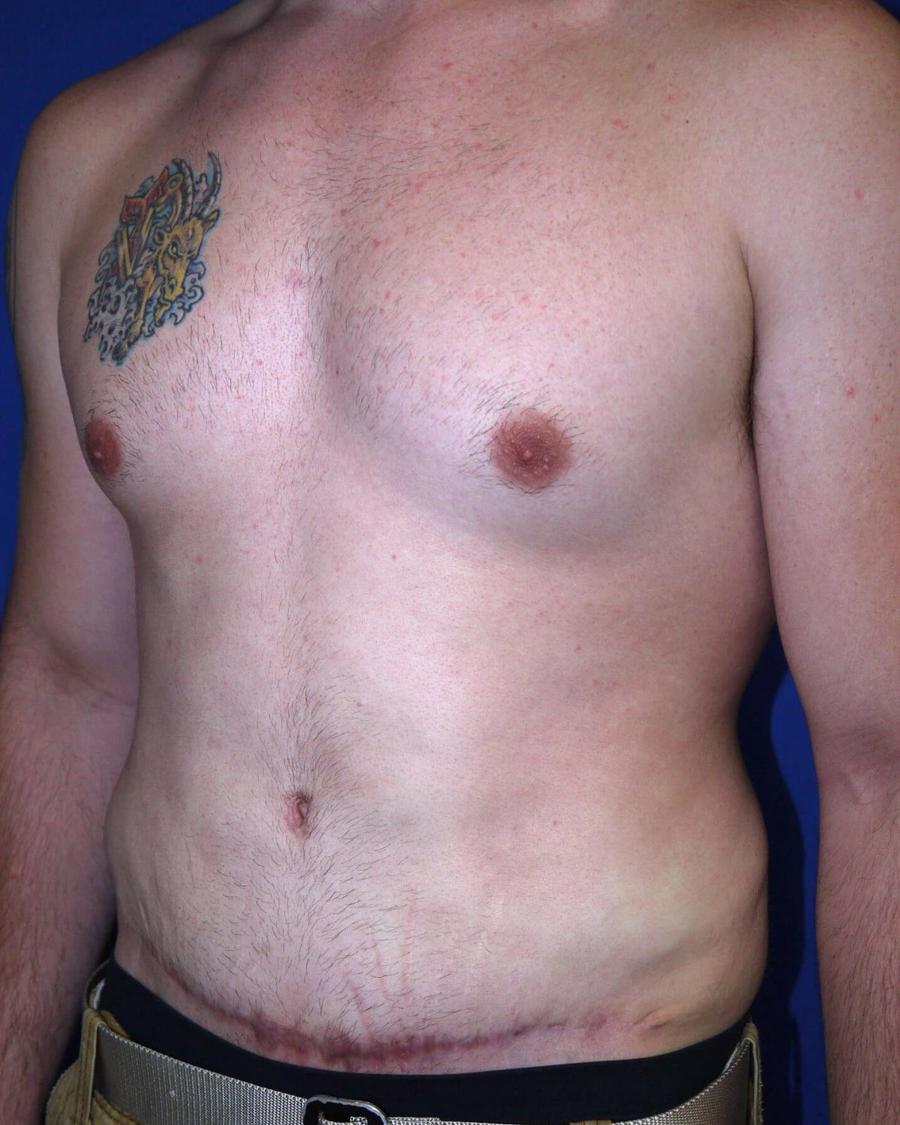 Tummy Tuck, Oblique Right view, after