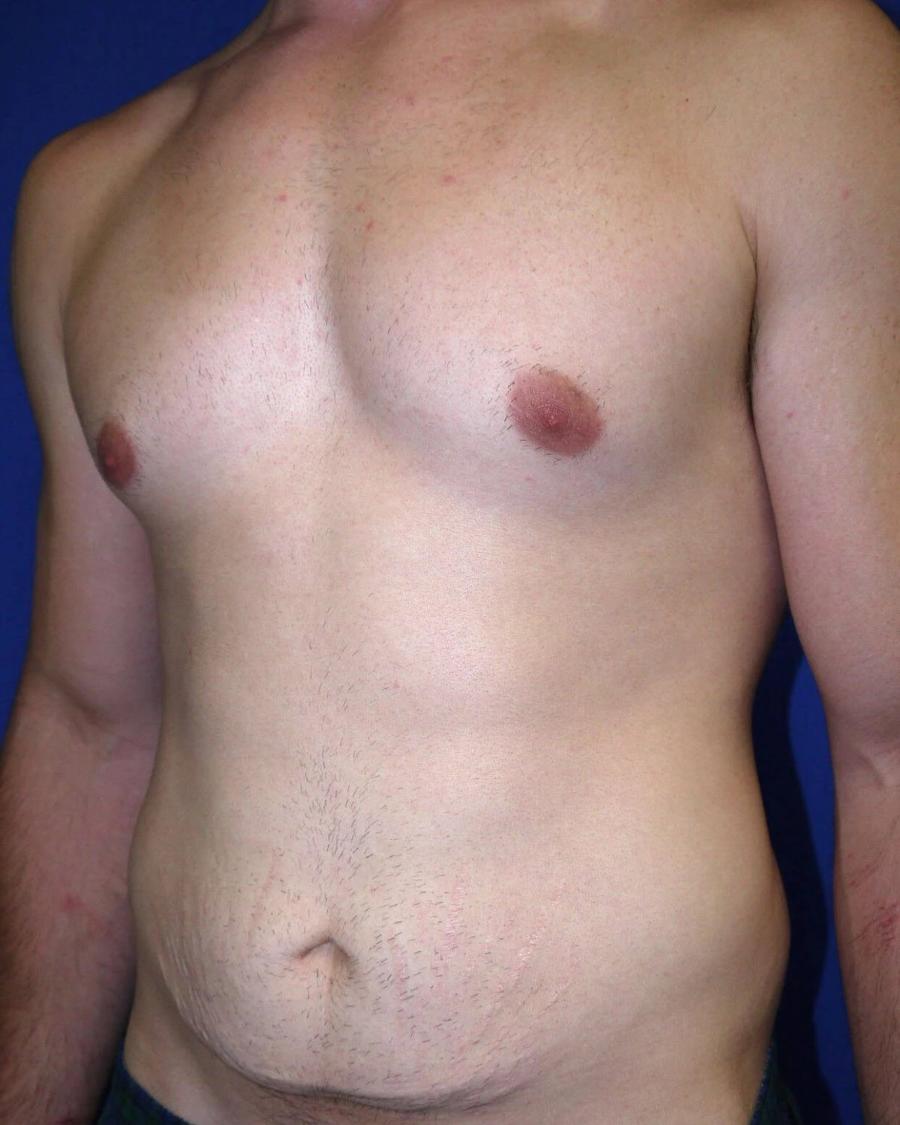 Tummy Tuck, Oblique Right view, before