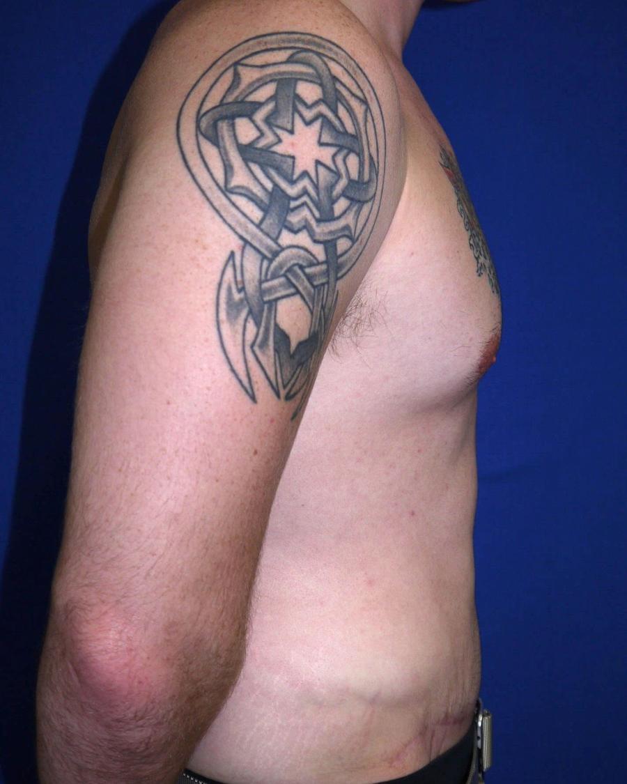 Tummy Tuck, Right Profile view, after